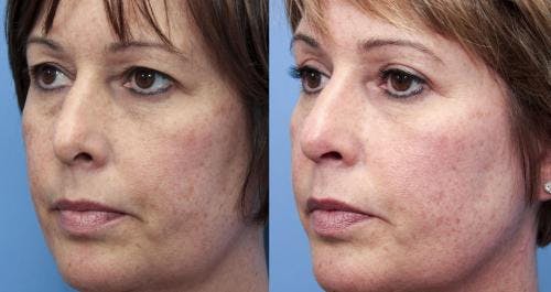 Eyelid Surgery (Upper Blepharoplasty) Before & After Gallery - Patient 58490533 - Image 2