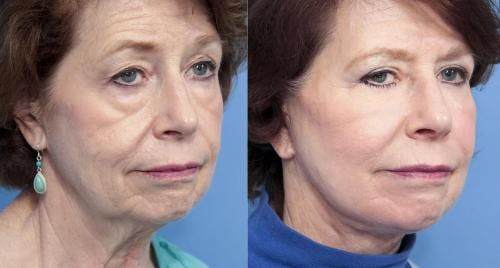 Fat Grafting Before & After Gallery - Patient 58490535 - Image 3