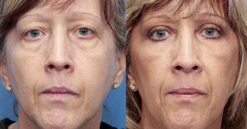 Eyelid Surgery (Upper & Lower Blepharoplasty) Before & After Gallery - Patient 260080 - Image 1