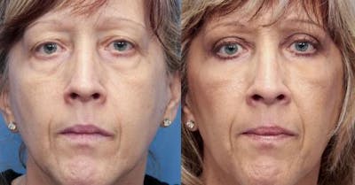 Eyelid Surgery (Upper & Lower Blepharoplasty) Before & After Gallery - Patient 260080 - Image 1