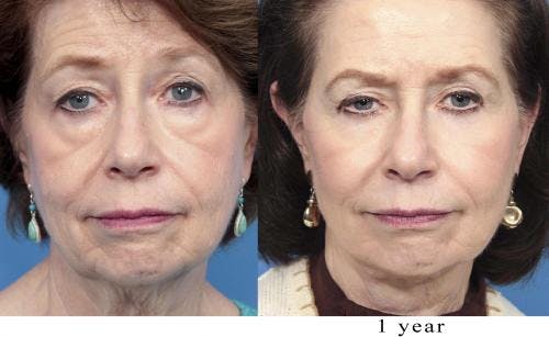 Fat Grafting Before & After Gallery - Patient 58490535 - Image 4