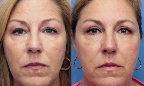 Eyelid Surgery (Upper Blepharoplasty) Before & After Gallery - Patient 58490536 - Image 1