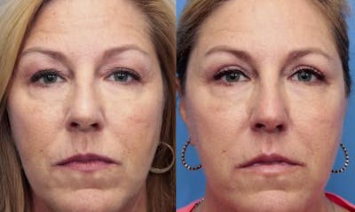 Eyelid Surgery (Upper Blepharoplasty) Before & After Gallery - Patient 58490536 - Image 1