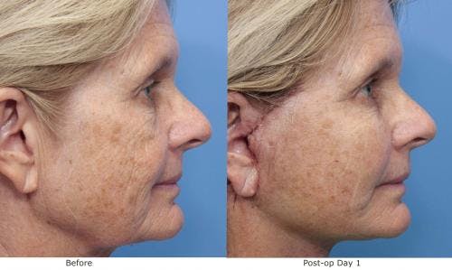Fat Grafting Before & After Gallery - Patient 58490537 - Image 2