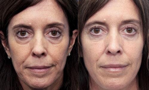 Eyelid Surgery (Lower Blepharoplasty) Before & After Gallery - Patient 358883 - Image 1