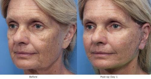 Fat Grafting Before & After Gallery - Patient 58490537 - Image 3