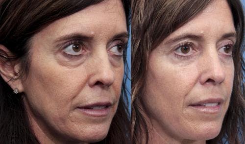 Eyelid Surgery (Blepharoplasty) Before & After Gallery - Patient 58490538 - Image 2