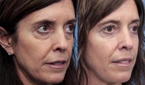 Eyelid Surgery (Lower Blepharoplasty) Before & After Gallery - Patient 358883 - Image 2