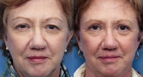 Eyelid Surgery (Blepharoplasty) Before & After Gallery - Patient 58490540 - Image 1