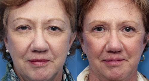 Eyelid Surgery (Upper Blepharoplasty) Before & After Gallery - Patient 58490540 - Image 1