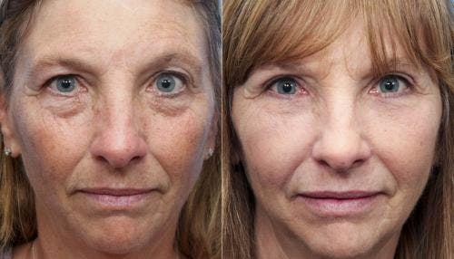 Eyelid Surgery (Upper & Lower Blepharoplasty) Before & After Gallery - Patient 408834 - Image 1