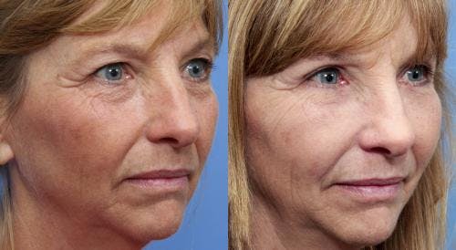 Eyelid Surgery (Blepharoplasty) Before & After Gallery - Patient 58490546 - Image 2