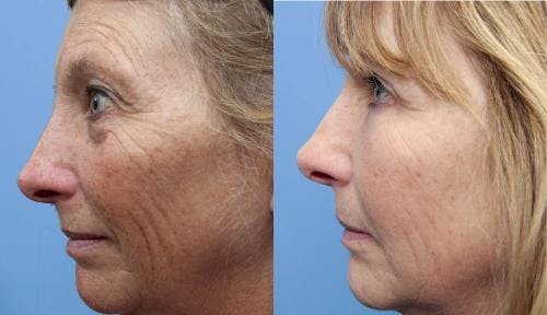 Eyelid Surgery (Upper & Lower Blepharoplasty) Before & After Gallery - Patient 408834 - Image 3