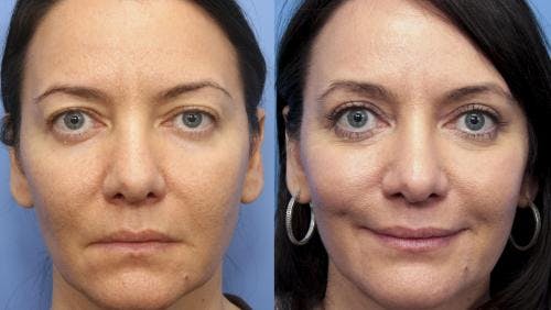 Eyelid Surgery (Upper Blepharoplasty) Before & After Gallery - Patient 58490547 - Image 1