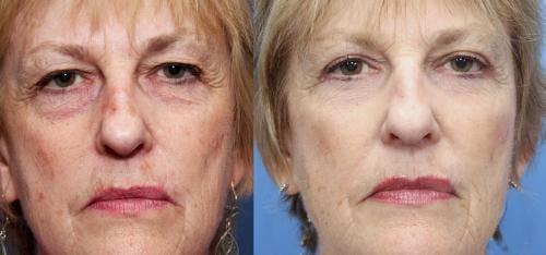 Eyelid Surgery (Upper & Lower Blepharoplasty) Before & After Gallery - Patient 159978 - Image 1