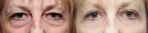 Eyelid Surgery (Blepharoplasty) Before & After Gallery - Patient 58490548 - Image 2