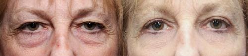 Eyelid Surgery (Upper & Lower Blepharoplasty) Before & After Gallery - Patient 159978 - Image 2