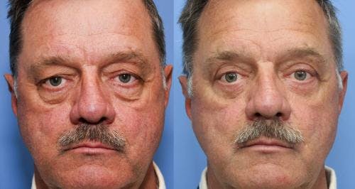 Eyelid Surgery (Blepharoplasty) Before & After Gallery - Patient 58490549 - Image 1