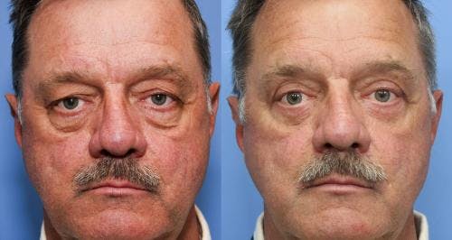 Eyelid Surgery (Upper & Lower Blepharoplasty) Before & After Gallery - Patient 312056 - Image 1