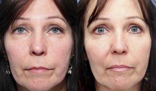 Eyelid Surgery (Blepharoplasty) Before & After Gallery - Patient 58490550 - Image 1