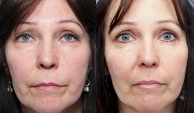 Eyelid Surgery (Upper Blepharoplasty) Before & After Gallery - Patient 58490550 - Image 1