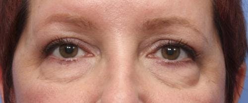 Eyelid Surgery (Blepharoplasty) Before & After Gallery - Patient 58490556 - Image 1