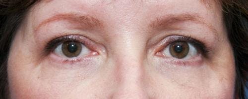 Eyelid Surgery (Upper & Lower Blepharoplasty) Before & After Gallery - Patient 336787 - Image 2