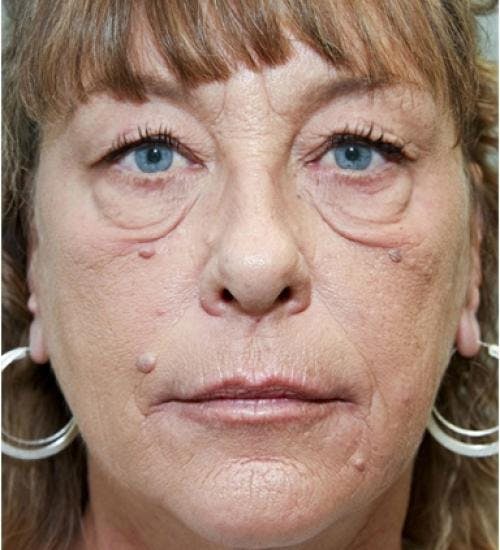 Eyelid Surgery (Blepharoplasty) Before & After Gallery - Patient 58490558 - Image 3