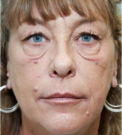 Eyelid Surgery (Upper & Lower Blepharoplasty) Before & After Gallery - Patient 920689 - Image 3