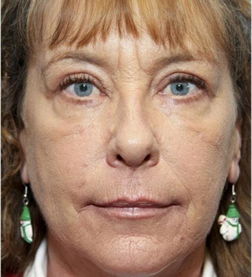 Eyelid Surgery (Blepharoplasty) Before & After Gallery - Patient 58490558 - Image 4