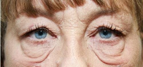 Eyelid Surgery (Blepharoplasty) Before & After Gallery - Patient 58490558 - Image 1