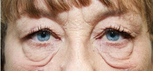 Eyelid Surgery (Upper & Lower Blepharoplasty) Before & After Gallery - Patient 920689 - Image 1