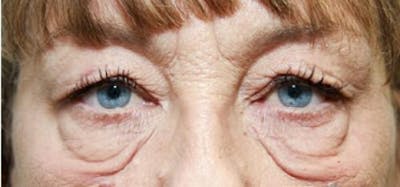 Eyelid Surgery (Upper & Lower Blepharoplasty) Before & After Gallery - Patient 920689 - Image 1