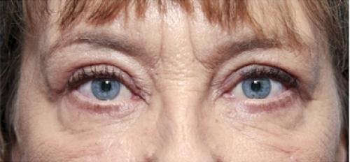 Eyelid Surgery (Upper & Lower Blepharoplasty) Before & After Gallery - Patient 920689 - Image 2