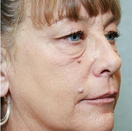 Eyelid Surgery (Upper & Lower Blepharoplasty) Before & After Gallery - Patient 920689 - Image 5