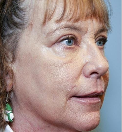 Eyelid Surgery (Upper & Lower Blepharoplasty) Before & After Gallery - Patient 920689 - Image 6