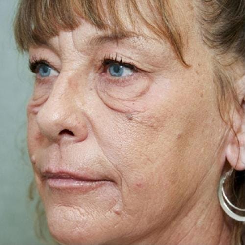 Eyelid Surgery (Upper & Lower Blepharoplasty) Before & After Gallery - Patient 920689 - Image 7