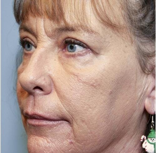 Eyelid Surgery (Upper & Lower Blepharoplasty) Before & After Gallery - Patient 920689 - Image 8