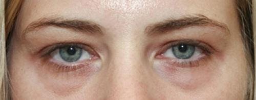 Eyelid Surgery (Blepharoplasty) Before & After Gallery - Patient 58490559 - Image 1