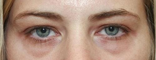 Eyelid Surgery (Lower Blepharoplasty) Before & After Gallery - Patient 200696 - Image 1