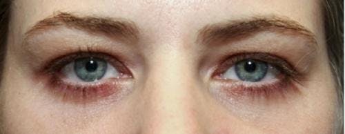 Eyelid Surgery (Lower Blepharoplasty) Before & After Gallery - Patient 200696 - Image 2