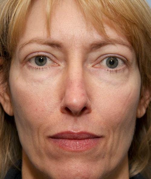 Eyelid Surgery (Upper & Lower Blepharoplasty) Before & After Gallery - Patient 113325 - Image 3