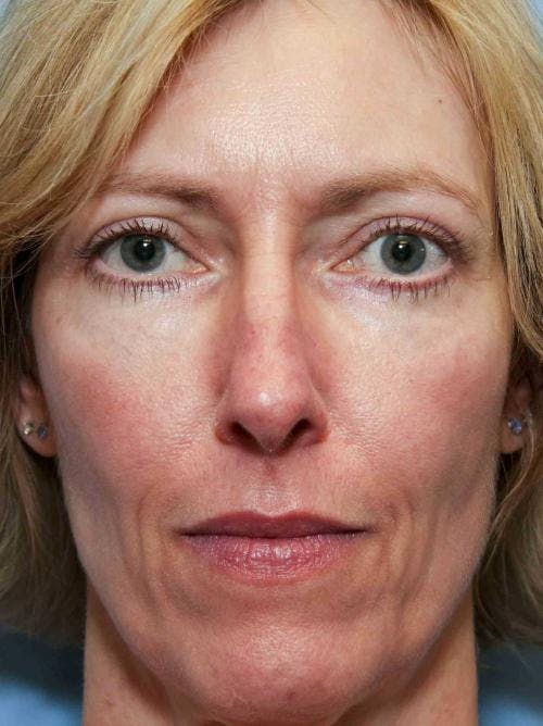 Eyelid Surgery (Upper & Lower Blepharoplasty) Before & After Gallery - Patient 113325 - Image 4
