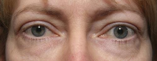 Eyelid Surgery (Blepharoplasty) Before & After Gallery - Patient 58490562 - Image 1