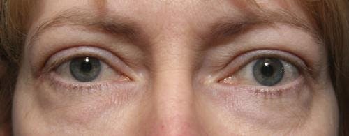 Eyelid Surgery (Upper & Lower Blepharoplasty) Before & After Gallery - Patient 113325 - Image 1