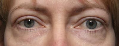 Eyelid Surgery (Upper & Lower Blepharoplasty) Before & After Gallery - Patient 113325 - Image 1