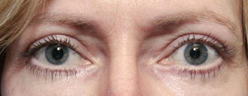 Eyelid Surgery (Blepharoplasty) Before & After Gallery - Patient 58490562 - Image 2