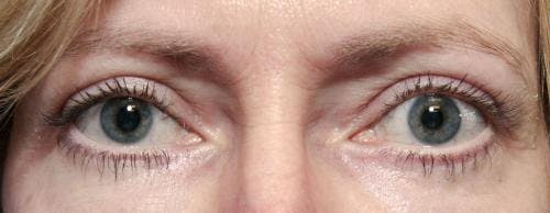 Eyelid Surgery (Upper & Lower Blepharoplasty) Before & After Gallery - Patient 113325 - Image 2