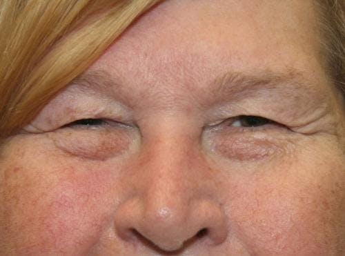Eyelid Surgery (Upper Blepharoplasty) Before & After Gallery - Patient 58490564 - Image 3