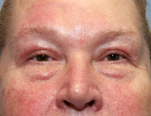 Eyelid Surgery (Upper Blepharoplasty) Before & After Gallery - Patient 58490564 - Image 4